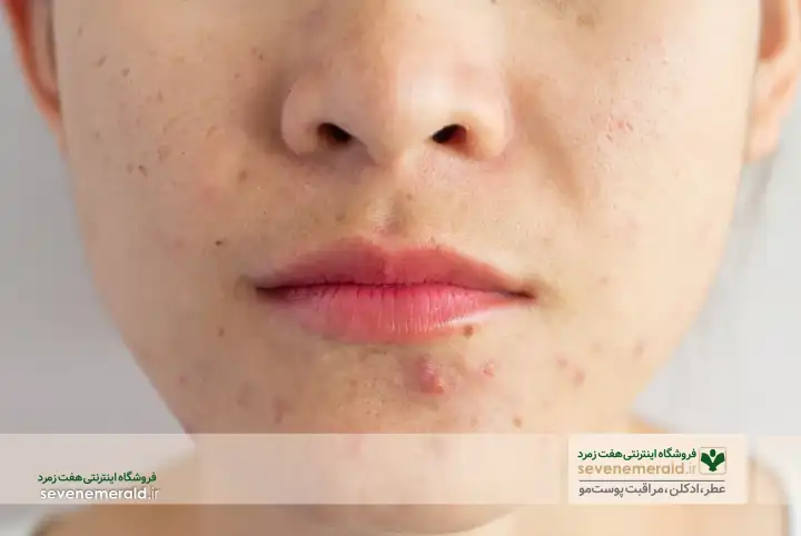 راه های از بین بردن جوش صورت