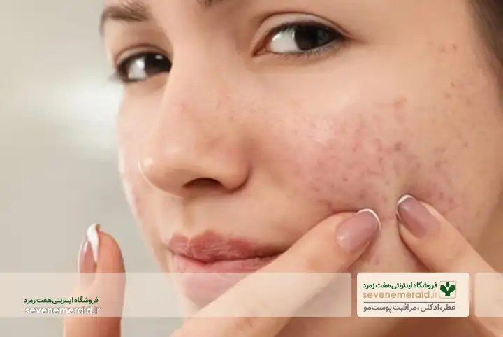 راهکار های مفید برای رفع جوش‌های صورت